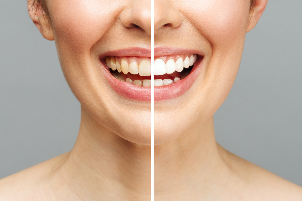 All About Teeth Whitening treatment in Seawoods