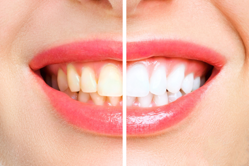 Professional Teeth Whitening Treatments in Seawoods